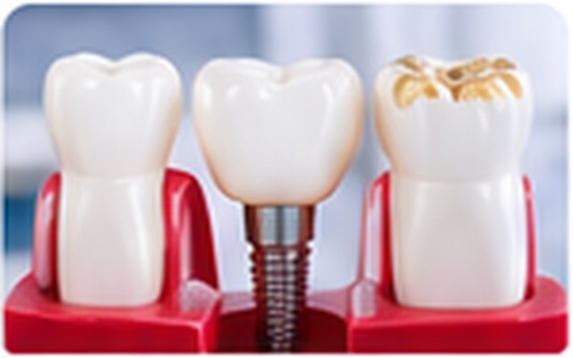 Dental Implants